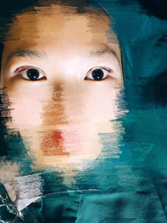 三点定位双眼皮永久吗 三点定位双眼皮恢复过程图片