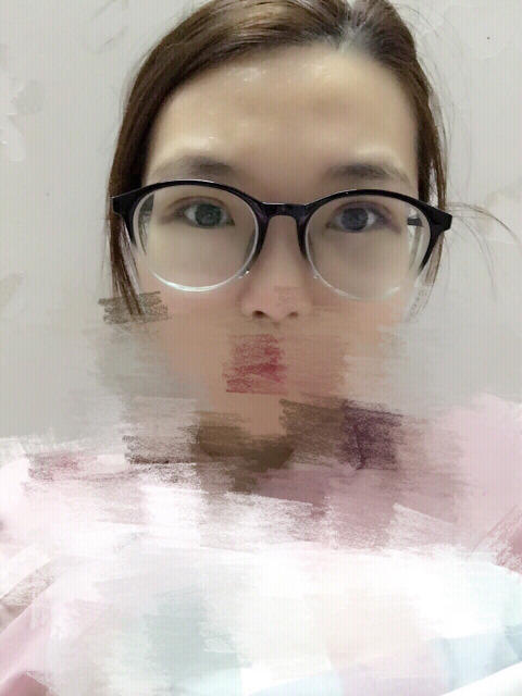 三点定位双眼皮永久吗 三点定位双眼皮恢复过程图片