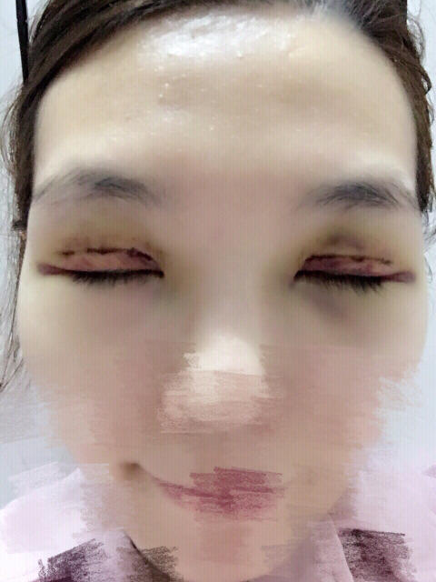 三点定位双眼皮永久吗 三点定位双眼皮恢复过程图片