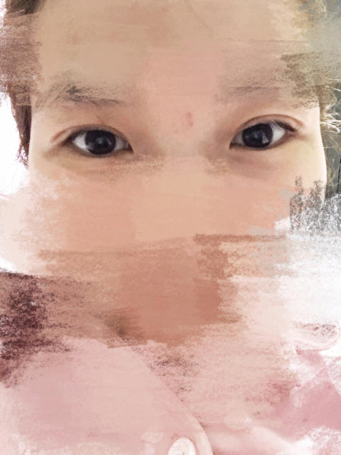 三点定位双眼皮永久吗 三点定位双眼皮恢复过程图片