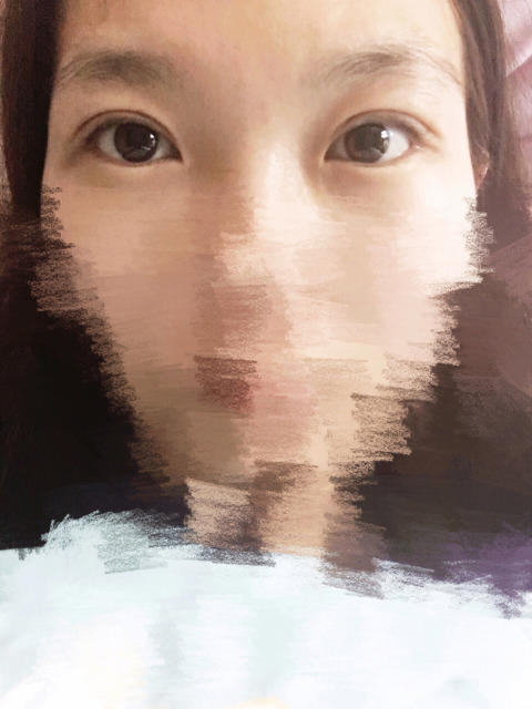 三点定位双眼皮永久吗 三点定位双眼皮恢复过程图片