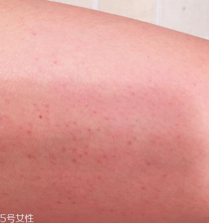 怎么去除鸡皮肤 跟你的鸡皮肤说再见