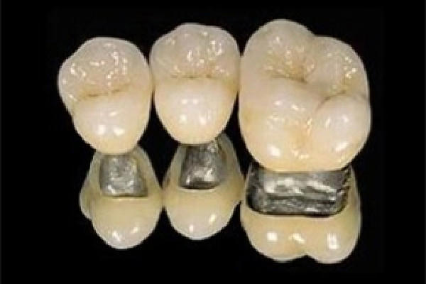 烤瓷牙的材料有几种 烤瓷牙用什么胶粘最好