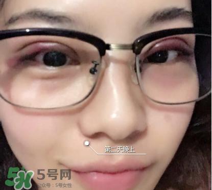 三点定位双眼皮过程图 做三点定位双眼皮心得