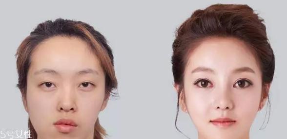 垫鼻尖需要多少钱 垫鼻尖手术价格高吗