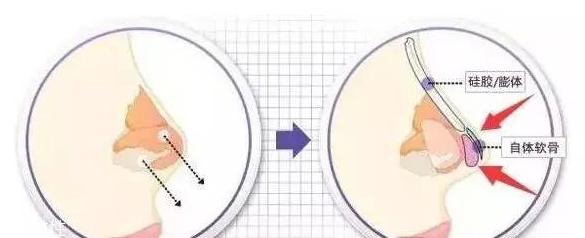 垫鼻尖需要多少钱 垫鼻尖手术价格高吗