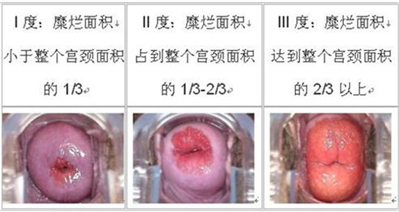 宫颈糜烂一二三度图片，别在傻傻认为是小病（对比图图片）
