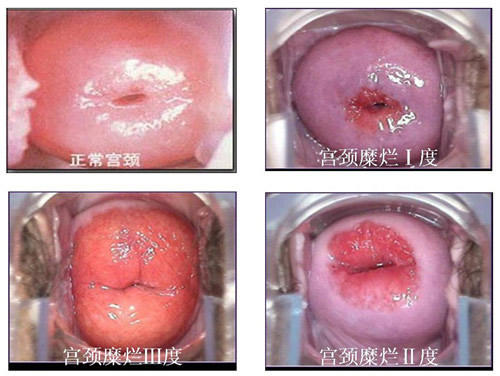 宫颈糜烂一二三度图片，别在傻傻认为是小病（对比图图片）