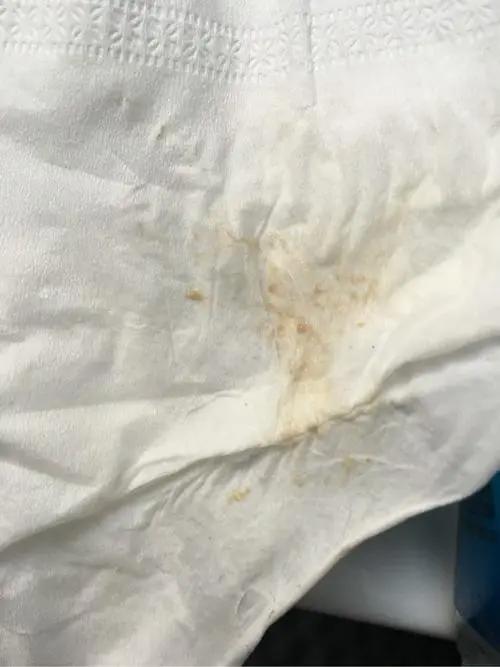 宫颈癌褐色分泌物图片高清，出现粉红色（宫颈癌早期三处痒两处不适