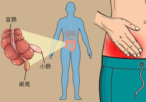 阑尾炎症状疼痛位置(阑尾炎3个压痛点图片)