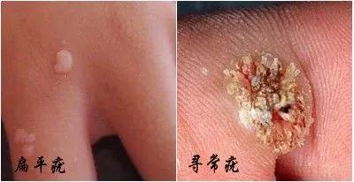 女性疣病是什么症状图片，4个早期千万不要忽略