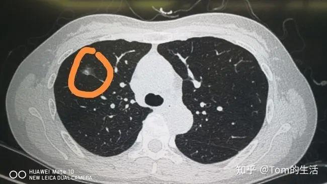 肺部结节最怕三个征兆,小心生长速度很快的结节