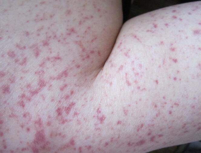 紫癜初期的图片及症状大全，皮肤上有小红血