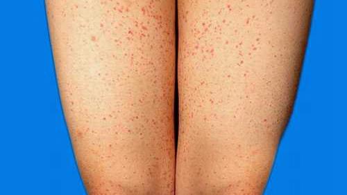 紫癜初期的图片及症状大全，皮肤上有小红血