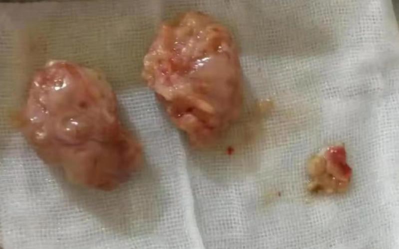 没有切除腺样体后悔到家了,一旦切除无法修复(孩子手术很心疼)