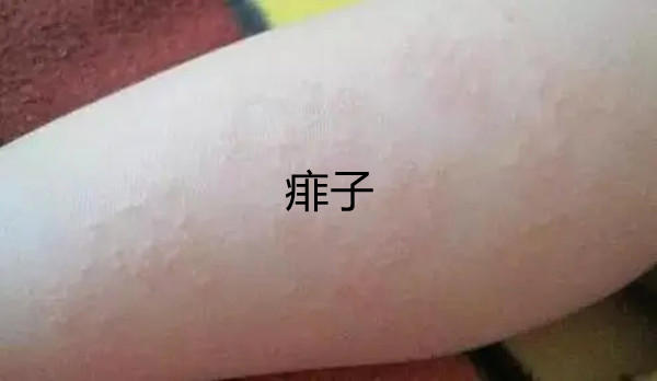 一张图教你区别湿疹和痱子,图文让你了解痱子和湿疹
