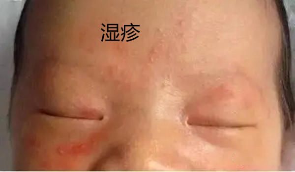 一张图教你区别湿疹和痱子，图文让你了解痱子和湿疹