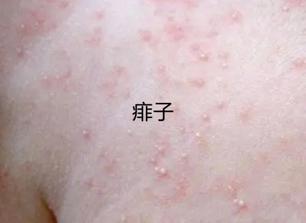 一张图教你区别湿疹和痱子，图文让你了解痱子和湿疹