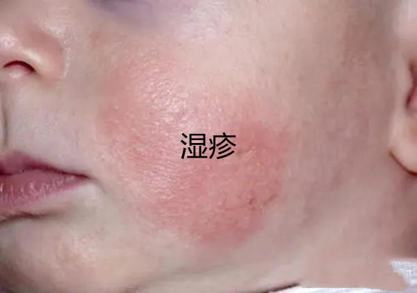一张图教你区别湿疹和痱子，图文让你了解痱子和湿疹