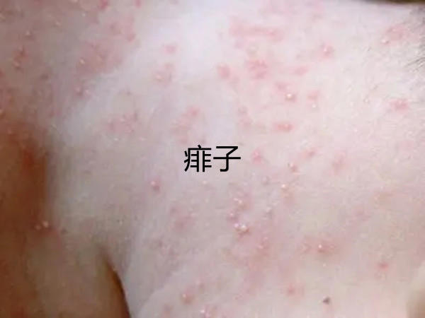 一张图教你区别湿疹和痱子，图文让你了解痱子和湿疹