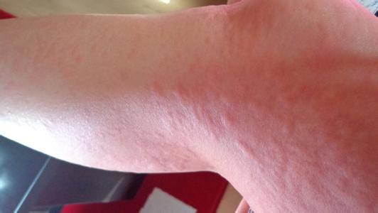 艾滋病一开始的皮肤图和初期症状，出现皮疹的皮肤呈红色