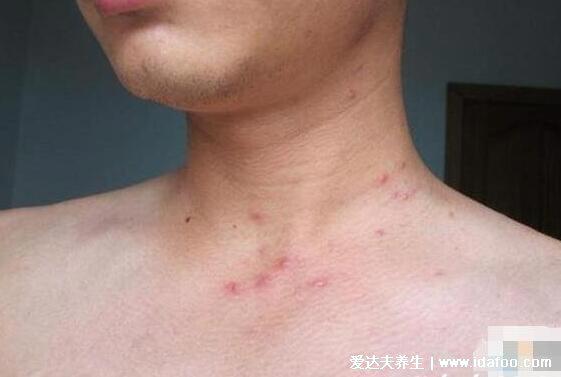 女人艾滋病的三大症状图片，浑身多个部位长小红点