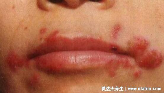 女人艾滋病的三大症状图片，浑身多个部位长小红点