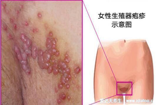 女人艾滋病的三大症状图片，浑身多个部位长小红点