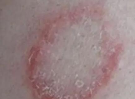 艾滋病初期手上水泡图片，水疱疹/手足口病不要慌（初期症状表现）