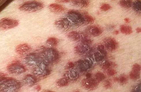 艾滋病初期手上水泡图片，水疱疹/手足口病不要慌（初期症状表现）