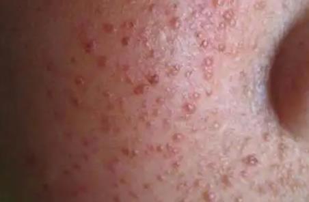 艾滋病初期手上水泡图片，水疱疹/手足口病不要慌（初期症状表现）