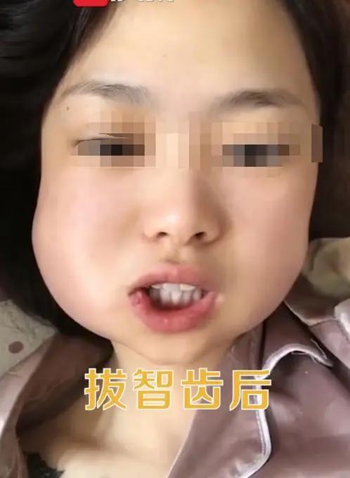 一次拔两颗智齿后悔死了,可能会出现发烧以及牙龈发炎的问题