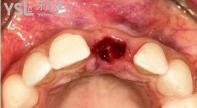 拔牙后留下的窟窿愈合过程（拔牙后七天窟窿恢复图）