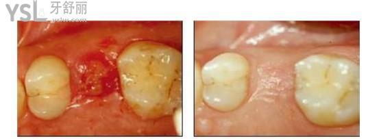 拔牙后留下的窟窿愈合过程（拔牙后七天窟窿恢复图）