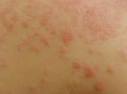 螨虫叮咬后的症状图，被螨虫寄生严重会溃烂