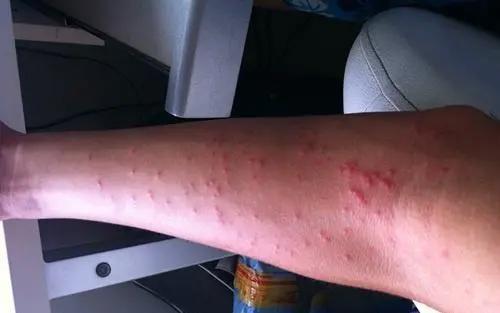 艾滋病的初期症状和身体反应，4个症状一定要引起注意
