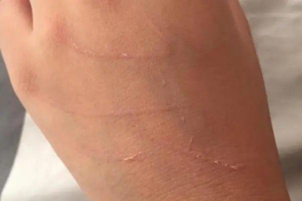 被猫抓了一下轻微破皮要打针吗,理论上来说不需要