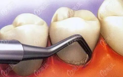 治疗牙周炎的7个简单偏方