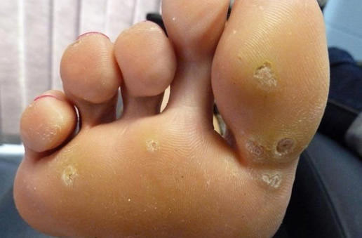 怎样判断是不是鸡眼图，鸡眼长什么样子图片