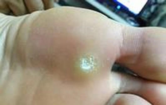 怎样判断是不是鸡眼图，鸡眼长什么样子图片