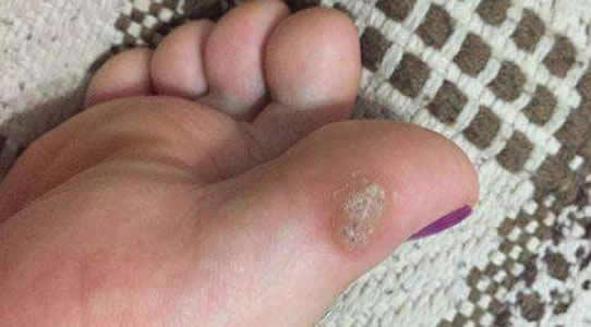 怎样判断是不是鸡眼图，鸡眼长什么样子图片