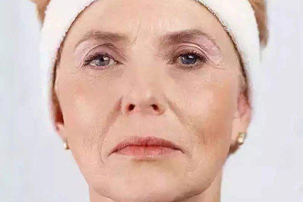 怎样去掉抬头皱纹，抬头皱纹怎么消除