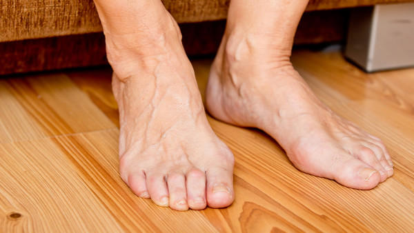 治疗风湿最好的药是什么？4类药物帮助治疗类风湿