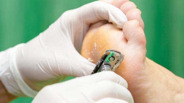 鸡眼怎么治疗好的快? 治疗鸡眼的几个最有效的方法