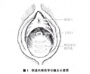 私处埋线、丁丁镶珠,真的能提升房事愉悦吗
