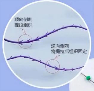 私处埋线、丁丁镶珠,真的能提升房事愉悦吗