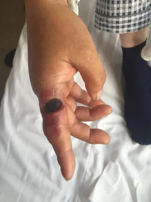 北京报告1例肺炭疽病例