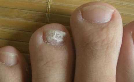 10个灰指甲大概多少钱