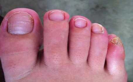 10个灰指甲大概多少钱