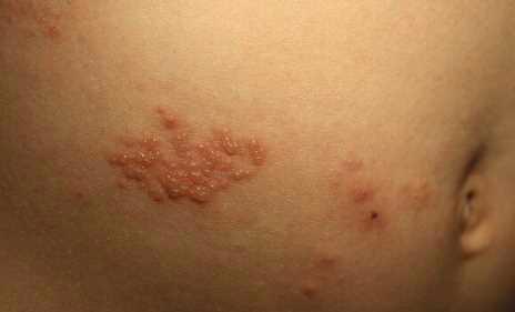 疱疹三天自愈的最佳方法有哪些